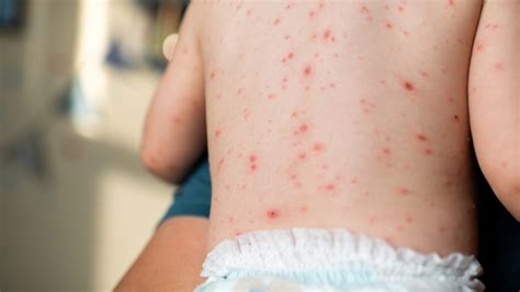 chickenpox  hand foot  mouth disease differences  images