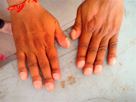 Clubbed Fingers Since Childhood at Robert Bible blog