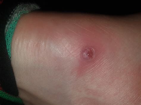Had this lump on my foot for a few years. Recently started bleeding