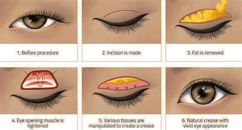 Full Incision Method of Double Eyelid Surgery » Grace Chua