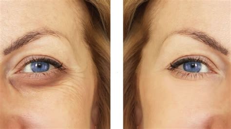Skinbooster Antes E Depois Olheiras