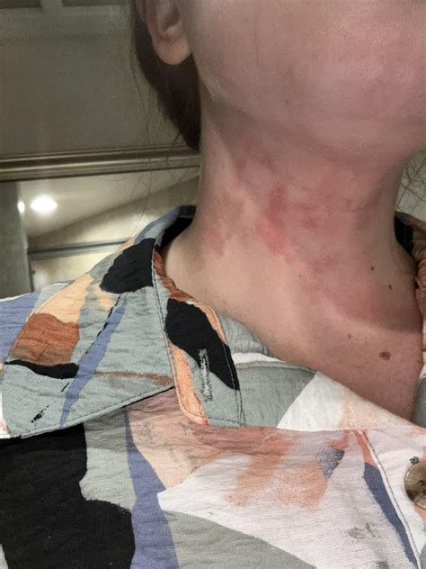 Mysterious recurring neck rashes : r/Autoimmune