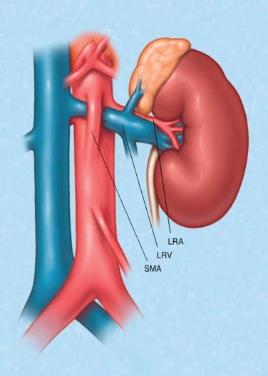 Nutcracker Syndrome Symptoms and Treatment – Costamedic