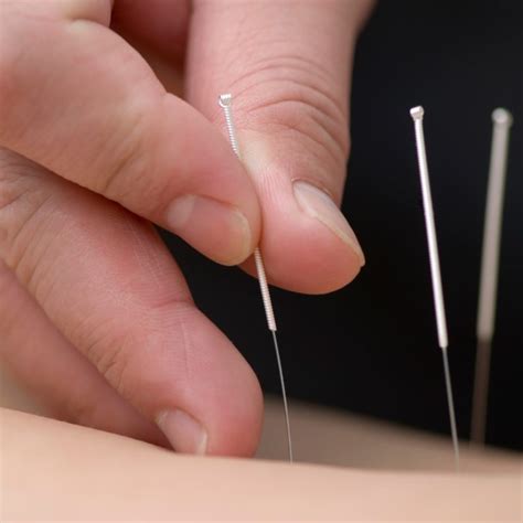 Acupuncture For Carpal Tunnel and Wrist Problems