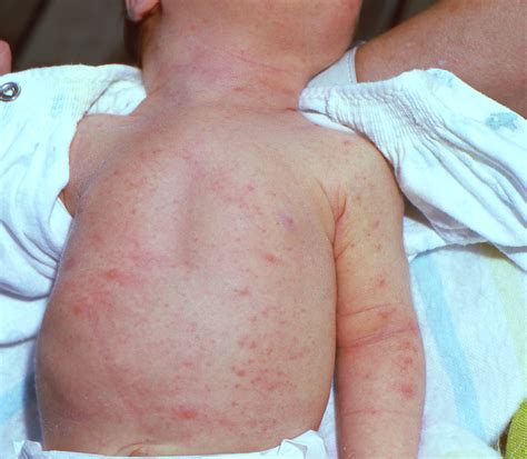Parents find flea bites newborn symptoms surprisingly itchy 25