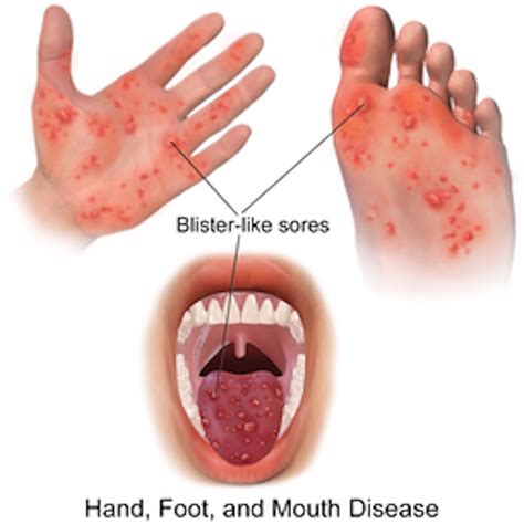 Hand, Foot and Mouth Disease (Causes, Symptoms, Treatment, Prevention)