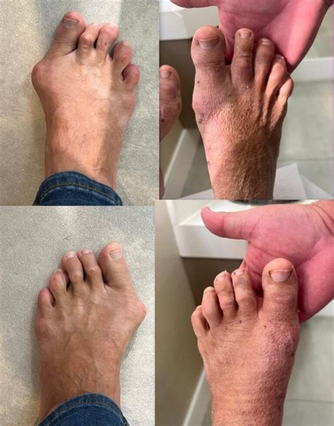 Cirurgia Joanete Antes E Depois - Cirurgia de Joanete: Quando Optar e Como Funciona - Dr. Thiago Protta