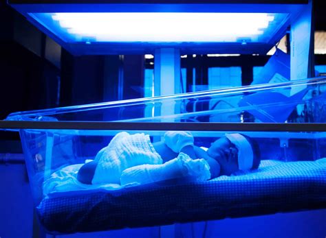 neonatal jaundice clinical  management teachmepaeds