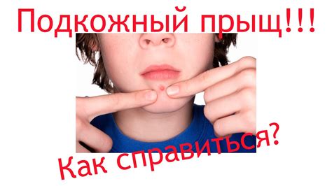 подкожный прыщ - YouTube