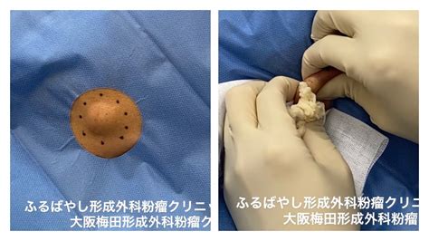 顔の粉瘤 ブログでも詳しく解説してます。くりぬき法 ふるばやし形成外科粉瘤クリニック 東京新宿院 大阪梅田形成外科クリニック - YouTube