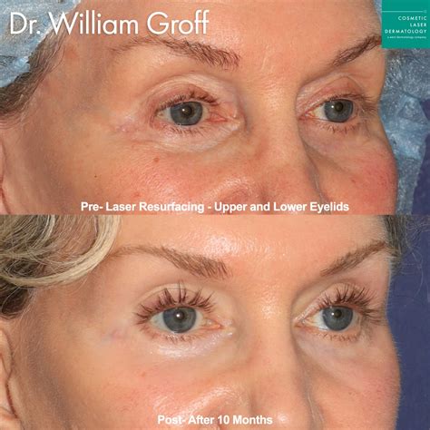 takeeyes san diego  surgical eye rejuvenation san diego