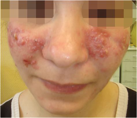 Is rosacea a systemic disease? - Clinics in Dermatology