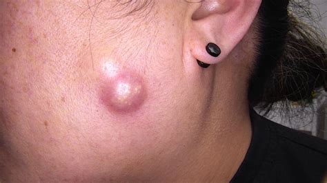 professional skin abscess drainage pus removal advance skin cancer