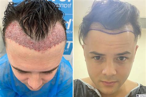 bad hair transplants  guide  prevention identification