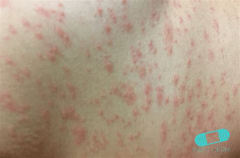 spots  rashes caused  viruses  dermatology