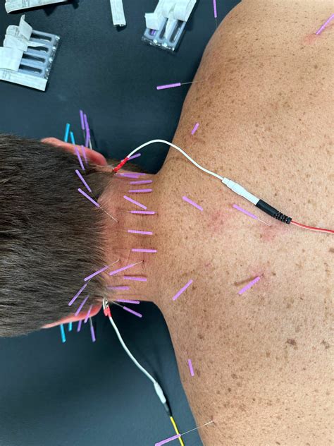 Dry Needling and Joint Manipulation to Treat and Resolve Benign