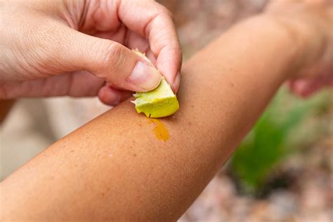 Babosa Em Ferida - Babosa no Tratamento de Queimaduras: Benefícios e Como Usar - Vuelo Pharma