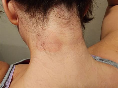 skin rash   coming  rdermatologyquestions