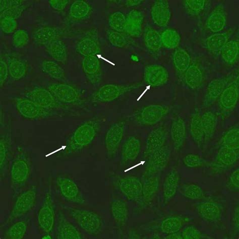 Patient II IIF Hep-2 staining pattern: Anti-centromere A staining ...