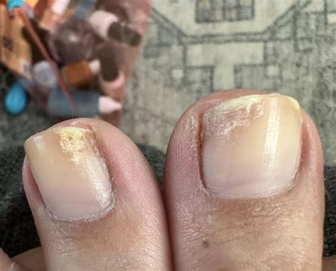 Toenail fungus never ending battle : r/NailFungus