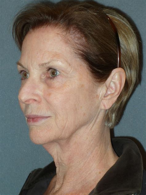 An Increaed Height Of The Lower Face 12