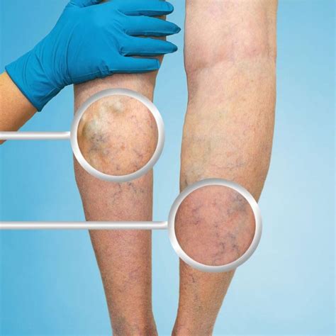 backup vein conditions georgia medical treatment center