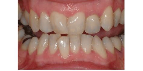 interproximal reductions  indication  technique references  bur