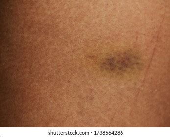 Bruised Leg Skin Accident Stock Photo 1738564286 | Shutterstock