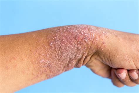 iStock-825903086-Hand-dermatitis