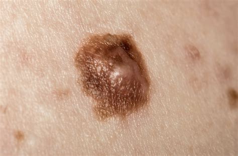 cancerous moles images symptoms  pictures