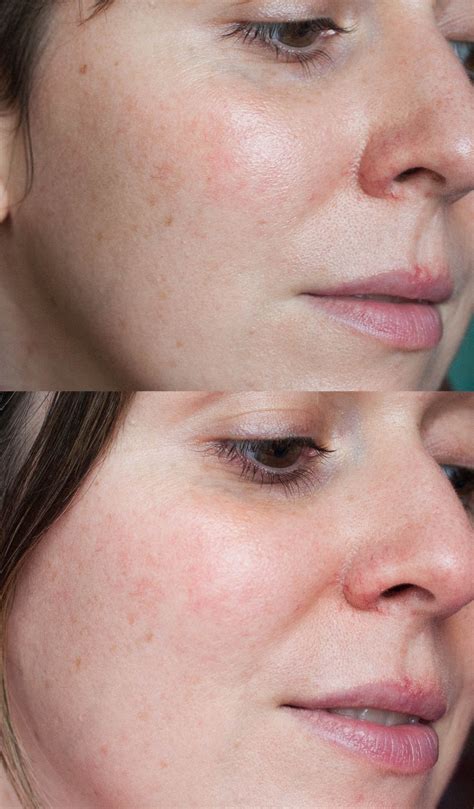Beauty: does dermarolling work? - THE STYLING DUTCHMAN.