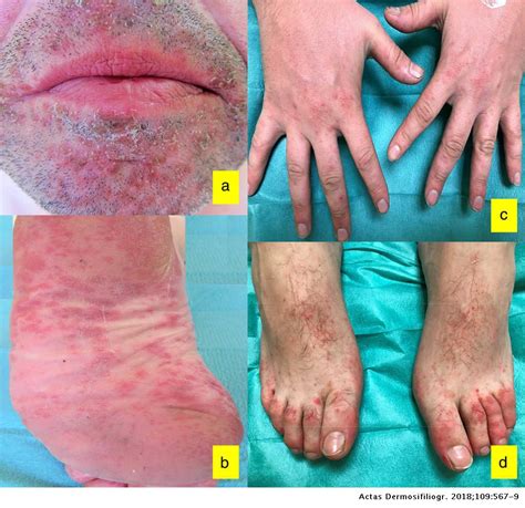 Mild Hand Foot And Mouth Disease Adult