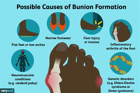 bunions symptoms  diagnosis  treatment