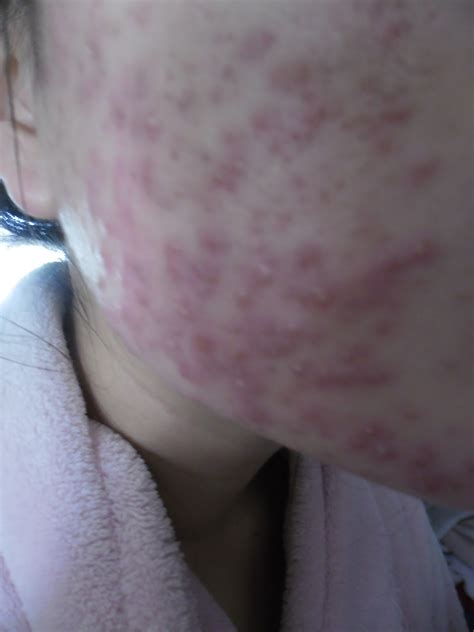 how to have clear skin 6