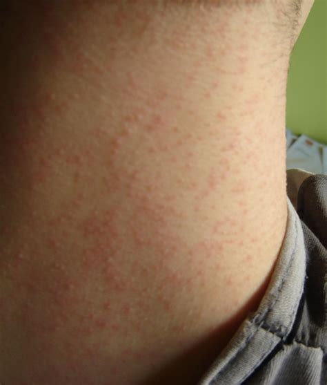 2010.2-3.Malassezia Foll - Our Dermatology Online