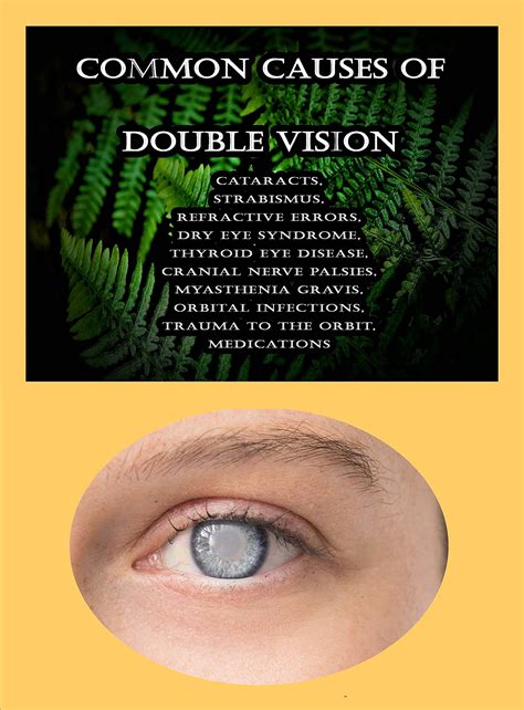 Common Causes Of Double Vision: Cataracts, Strabismus, Refractive