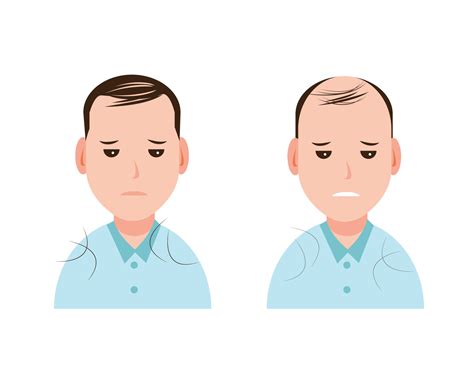 Male pattern baldness, alopecia, type of hair loss in men vector