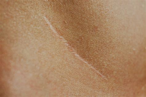 Side Effects of Cancer Treatment | MD Anderson Cancer Center