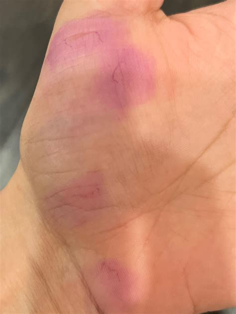 Are these burrows? Ink test : r/scabies