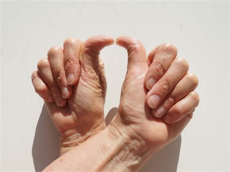 Why double-jointed people are more likely to have health problems