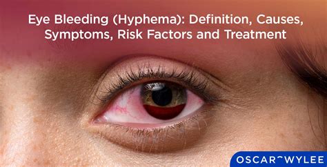 Eye Bleeding (Hyphema): Definition, Causes, Symptoms, Risk Factor and ...