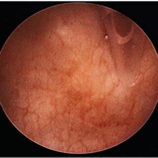 The opening on the uterine fundus | Download Scientific Diagram