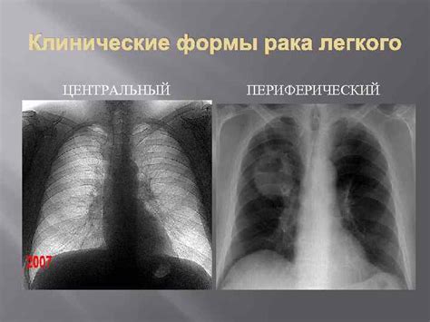 РАК ЛЕГКИХ 1 Эпидемиология 2 Этиология 3 Клиника
