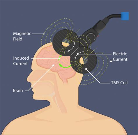 science  tms brain mapping gemini tms daytona fl