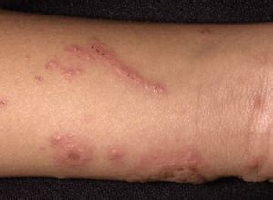 Rash in Infants and Young Children - Pediatrics - Merck Manual ...