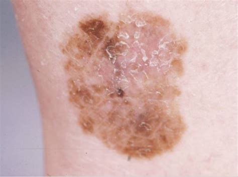 melanoma concise medical knowledge