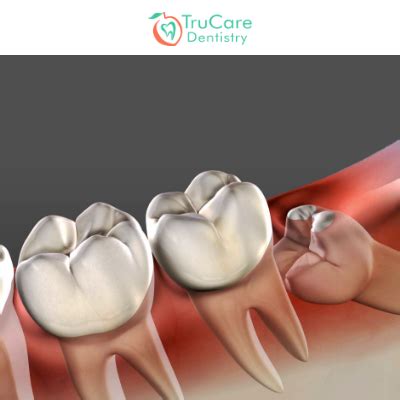 partially impacted wisdom teeth