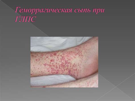 Геморрагическая лихорадка с почечным синдромом - презентация онлайн