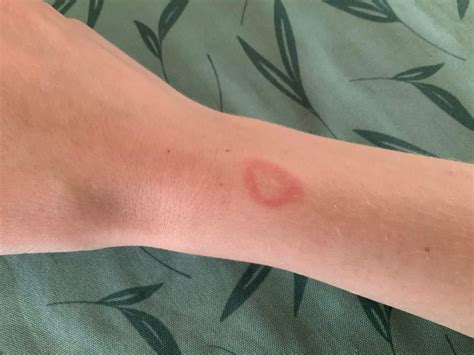 Könnte das Wanderröte von einem Zeckenbiss sein? (Gesundheit und Medizin)