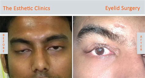 drooping eyelids affect vision  eye health  taarini gupta